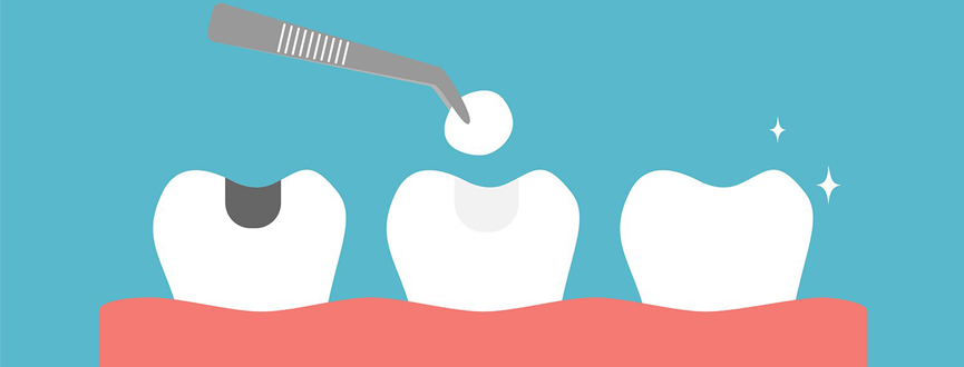 อุดฟัน Fill Teeth