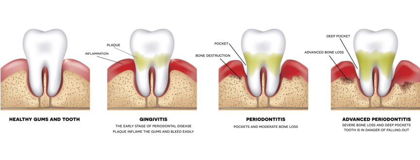 อุดฟัน Fill Teeth