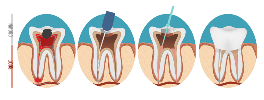 รักษารากฟัน Root Canal Treatment