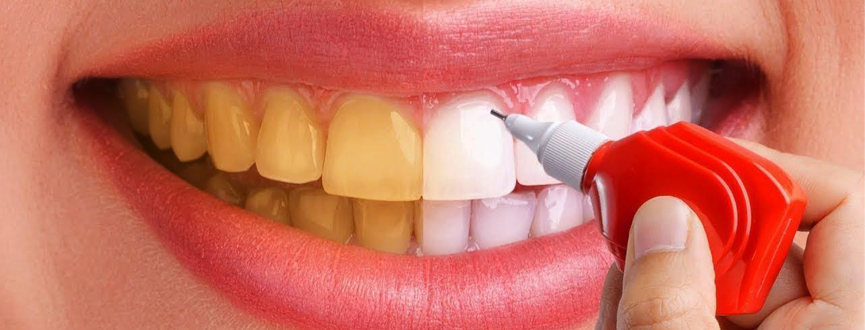 ฟอกสีฟัน Teeth Bleaching